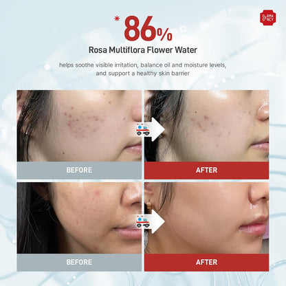 Zeroca 86 Korean Toner for Acne-Prone & Oily Skin – Fast Calming & Soothing for Breakout Relief – Calms Redness & Supports Clear Skin (6.76 fl.oz. 200ml)