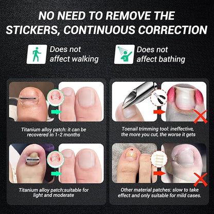 Titanium alloy ingrown toenail treatment