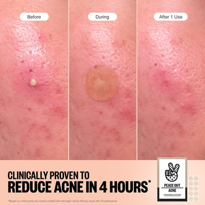 PEACE OUT Acne Healing Dots Helps Clear Blemishes Overnight, Fast Acting Hydrocolloid Pimple Patches for Breakouts with Salicylic Acid, Retinol and Aloe Vera, Award Winning Skincare Solution 60 Count