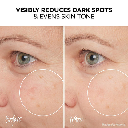 Olay Pro-X Dermatological Even Skin Tone Spot Fading Treatment Serum, 1.3 oz