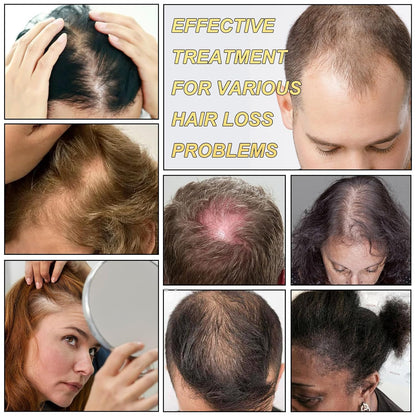 5% Minoxidil for Men and Women Hair Growth Serum, Biotin Hair Growth, Hair Regrowth Treatment for Scalp Hair Loss Hair Thinning for Thicker Longer Fuller Healthier Hair (Pack of 2)