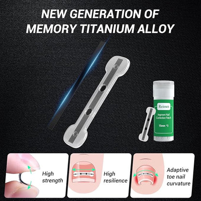 Titanium alloy ingrown toenail treatment
