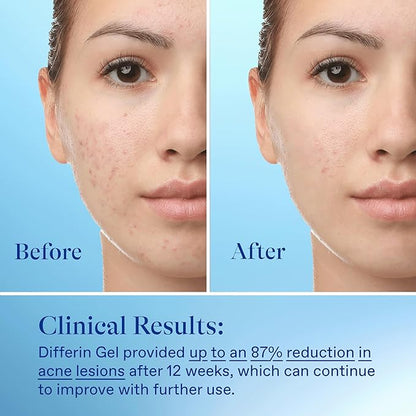 Differin acne treatment gel, 60