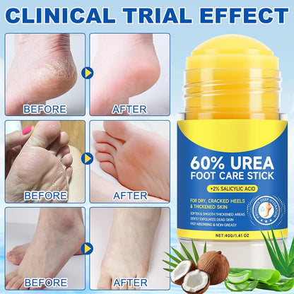 Urea Cream Stick 60% plus 2% Salicylic Acid,urea cream percent for feet maximum strength,Foot Lotion Stick for Cracked Heels,Dry Hands & Rough Knees,Callus Remover & Skin Softener, Soften Dead (1)