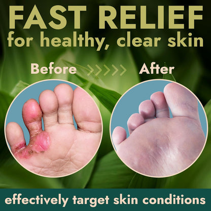 Tea Tree Oil Antifungal Foot Gel | Relieves Jock Itch, Athlete’s Foot & Ringworm | Soothes Itching & Burning | Moisturizes Dry, Cracked Feet | No-Touch Applicator | 1-Week Treatment Option | 20g