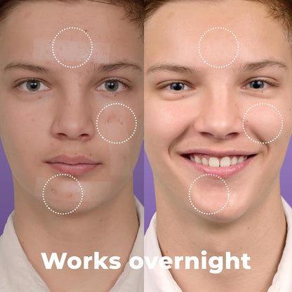 Large Pimple Patches for Face (20 Pack), Treat Blemishes Overnight, Hydrocolloid Acne Patch, Hydrocolloid Bandages, Big Pimple Patches, Large Acne Patch