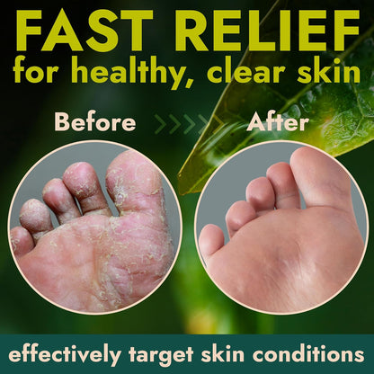 Foot Cream with Tea Tree Oil | Antifungal Cream to Soothes Cracked Heels, Dry Skin & Itchy Feet | Helps with Athlete’s Foot, Nail Fungus & Jock Itch | Relieves Itching & Burning | 4.05 fl oz